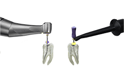 歯科用根管拡大装置