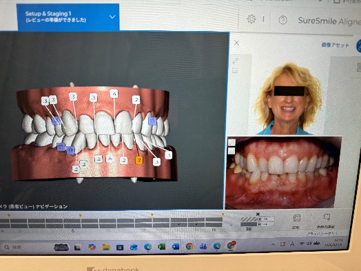 マウスピース型カスタムメイド矯正装置（SureSmile）