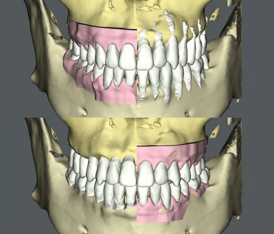 マウスピース型カスタムメイド矯正装置（SureSmile）