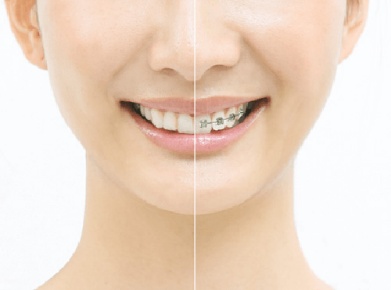 マウスピース型カスタムメイド矯正装置（SureSmile）