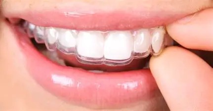 マウスピース型カスタムメイド矯正装置（SureSmile）