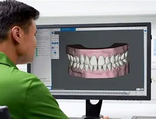 マウスピース型カスタムメイド矯正装置（SureSmile）