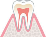 初期（歯肉炎）