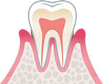 軽度の歯周炎