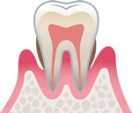 中等度の歯周炎