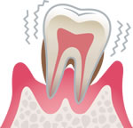 重度の歯周炎